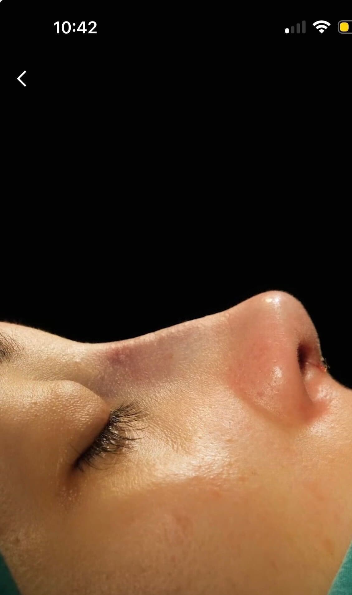 Maya’s nose in profile, post-op.